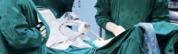机械臂在肺段切除手术中使用